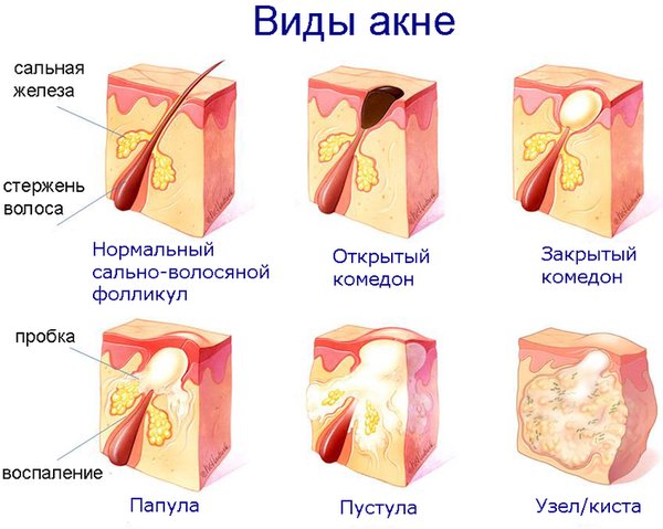 акне