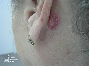 Базалиома в области за ушной раковиной. Фото.