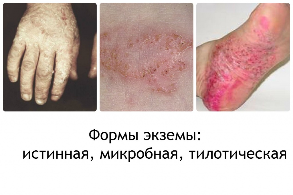 экзема