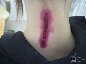 nevus posle 2.jpg